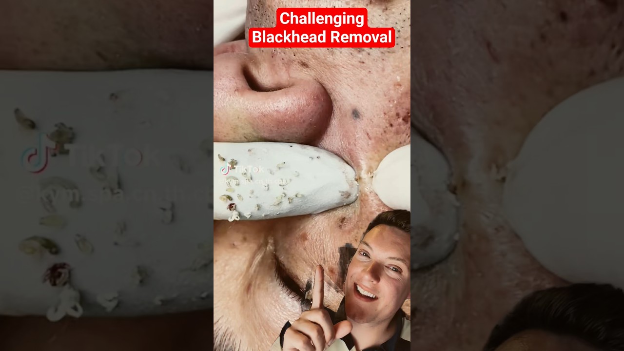 Challenging BLACKHEAD REMOVAL - So Many Crazy Blackheads #shorts