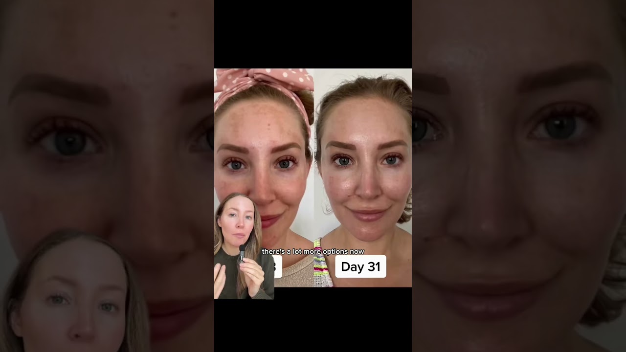 everything I do for my melasma ⬇️ more in comments