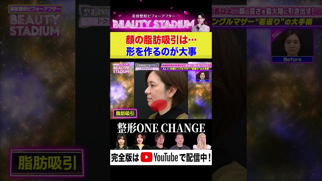 【美容整形】顔の脂肪は取れば取るだけ良いわけではない！？一番大切なのは…