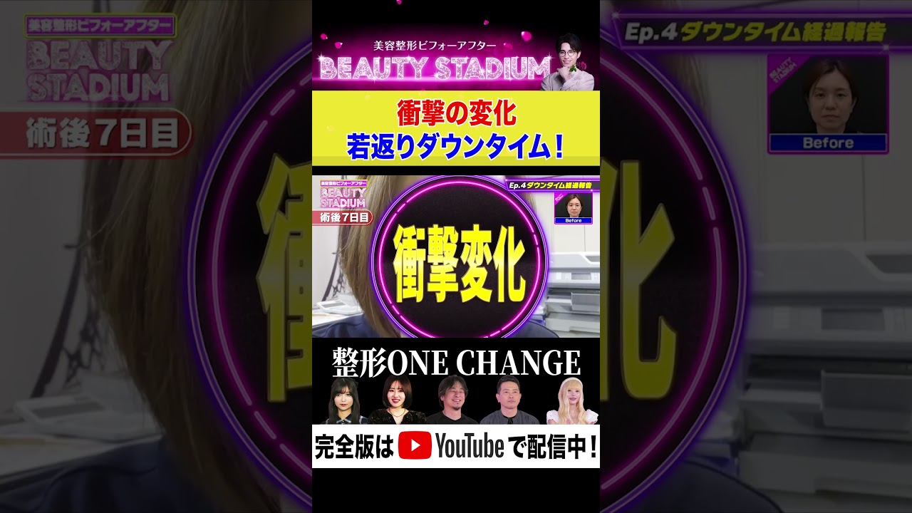 【美容整形】 若返り手術で衝撃の変化！ダウンタイム大公開！