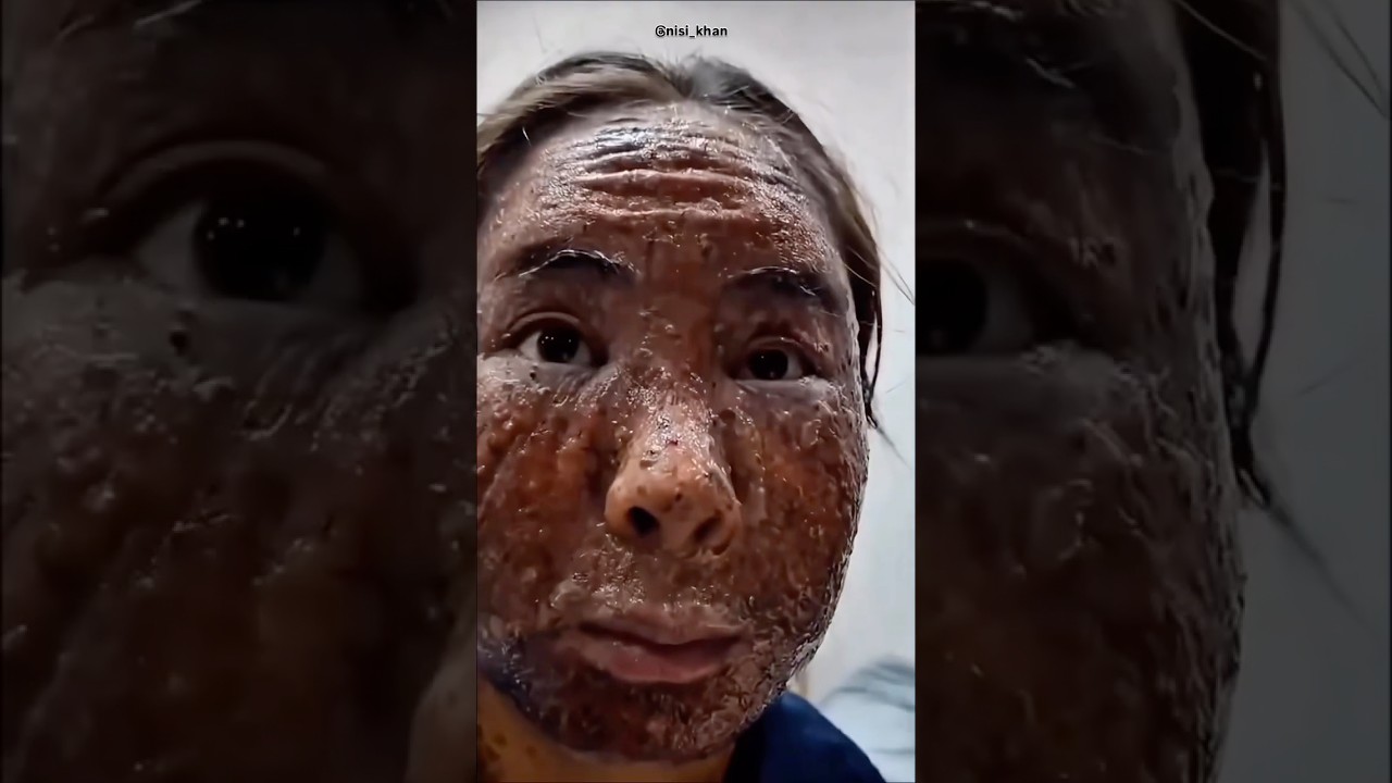 Dark spots🥰 Not anymore!#darkspots #ytshorts #yt