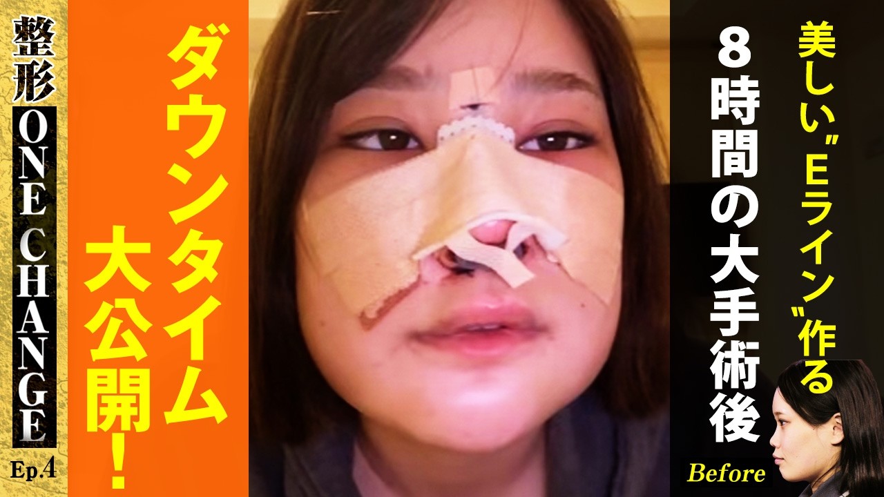 美しい”Eライン”作る 8時間の大手術後 ダウンタイム大公開！【整形ONE CHANGEドクターバトル#4 | DT編 | Eライン】
