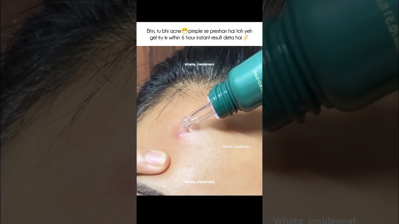 Remove Pimple or acne in 6 hour 😱#afufinds#pimple#acne #skincare #viral #trending #share #kritisanon