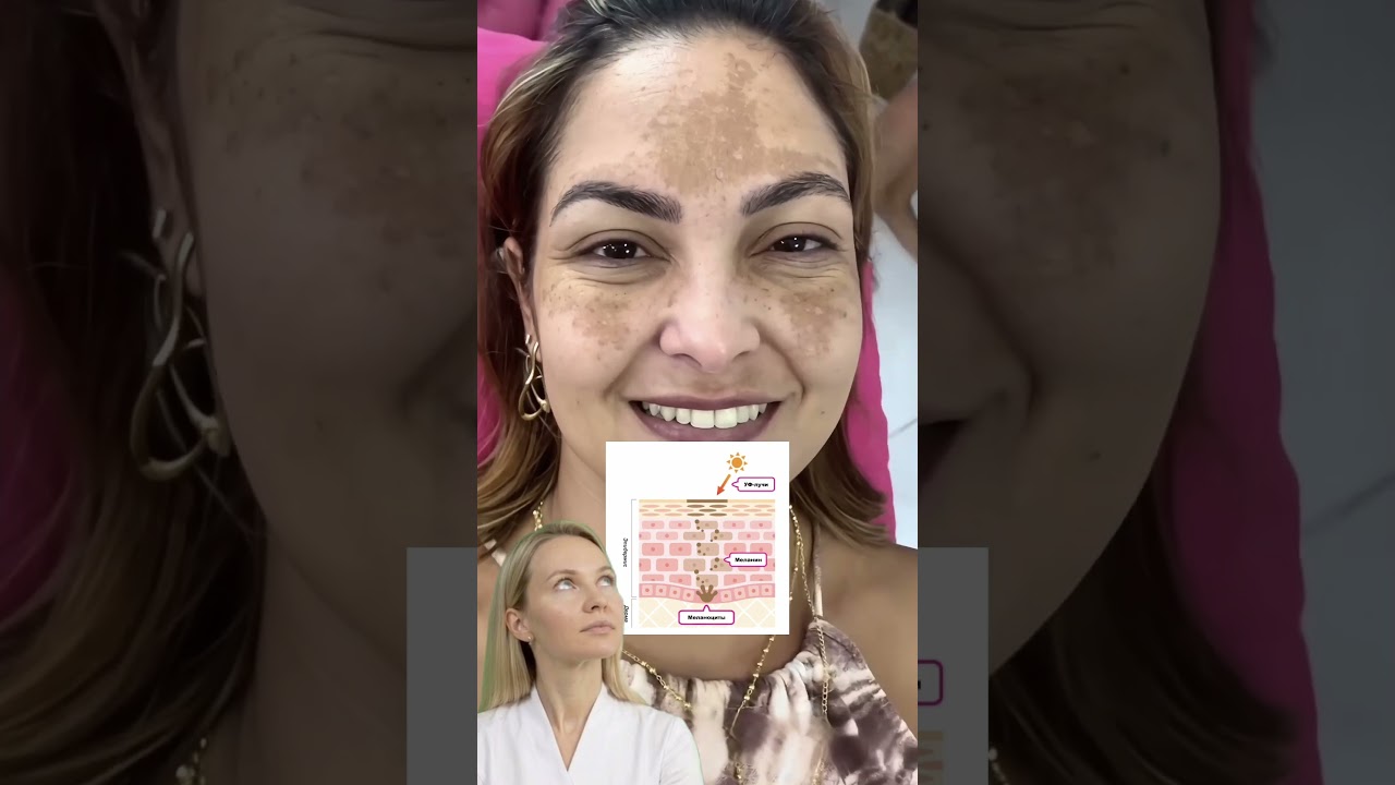 Умный пилинг от пигментации #WW123362 Арт ВБ Cosmeya  #уходзакожей #пигментация #пилинг #кислоты