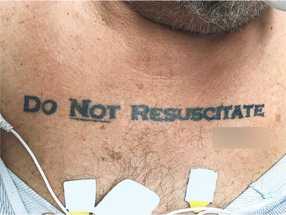 Correspondence: An Unconscious Patient with a DNR Tattoo https://t.co/6gBO0m154O #MedicalEthics 